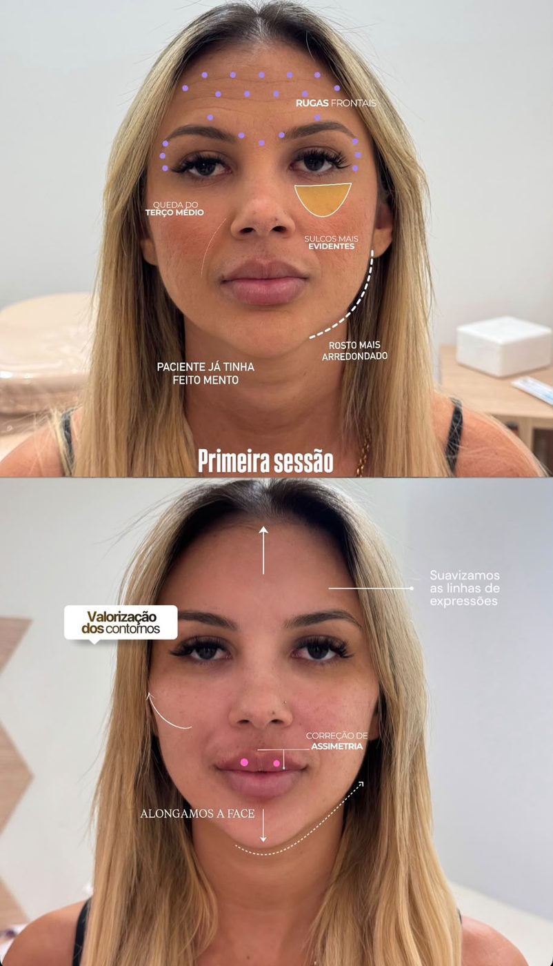 Antes e depois de harmonização facial full face