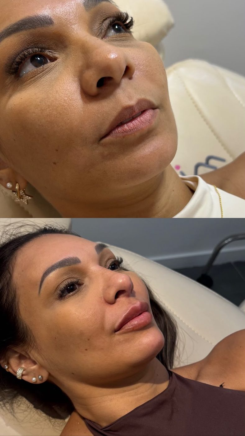 Antes e depois de preenchimento labial e contorno