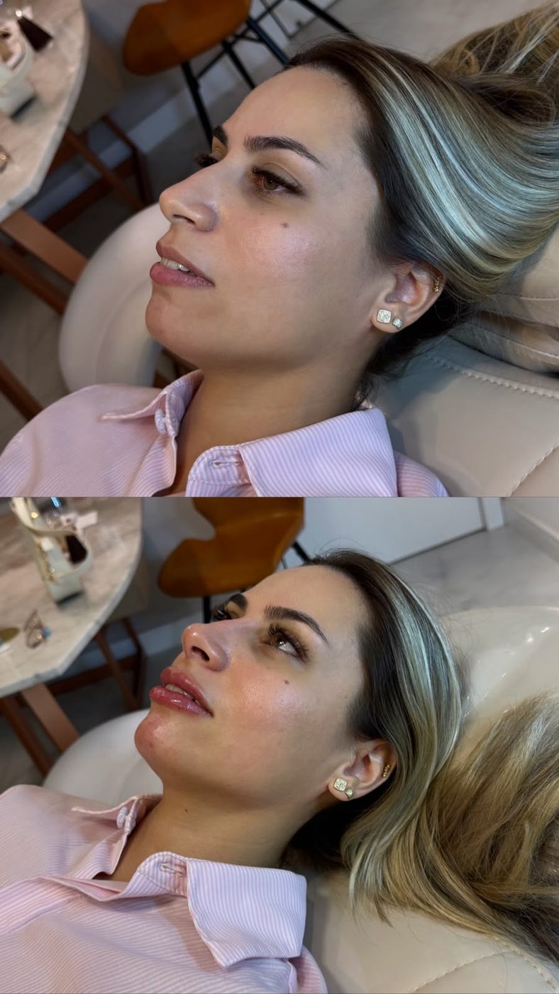 Antes e depois de preenchimento labial