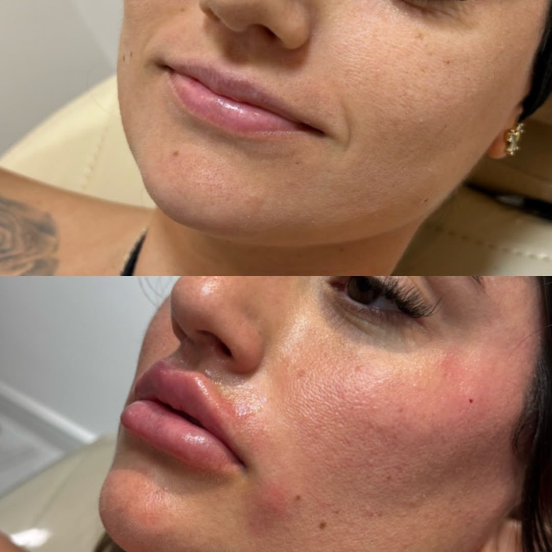 Antes e depois de volume e contorno dos lábios