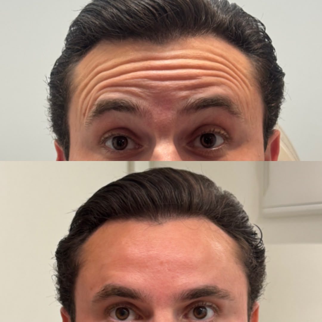 Antes e depois de toxina botulínica nas linhas da testa