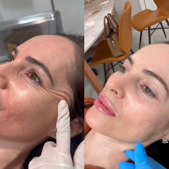 Antes e depois do protocolo Skin Reset na região dos olhos